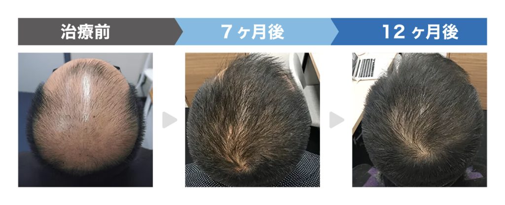 AGAヘアクリニックの治療事例