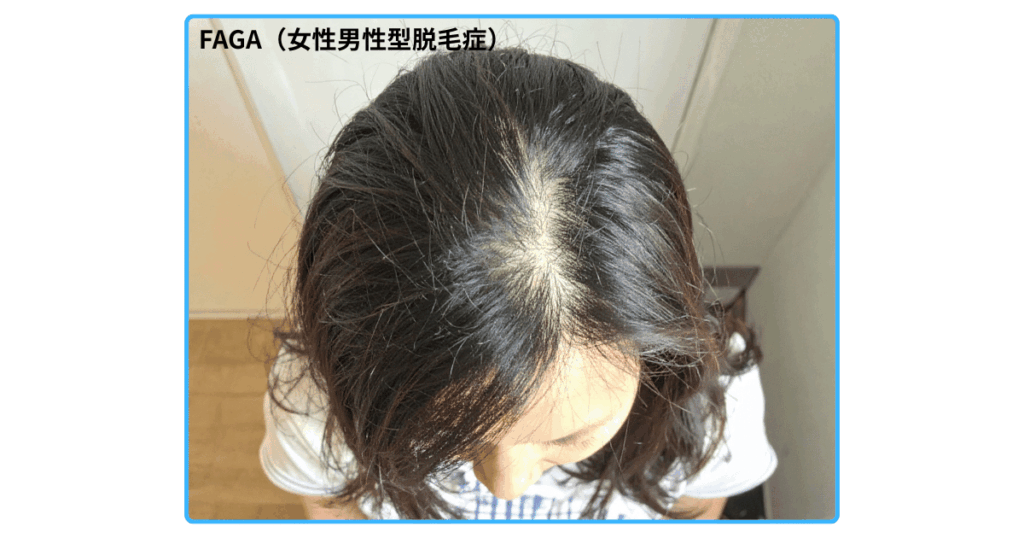 FAGA（女性男性型脱毛症）