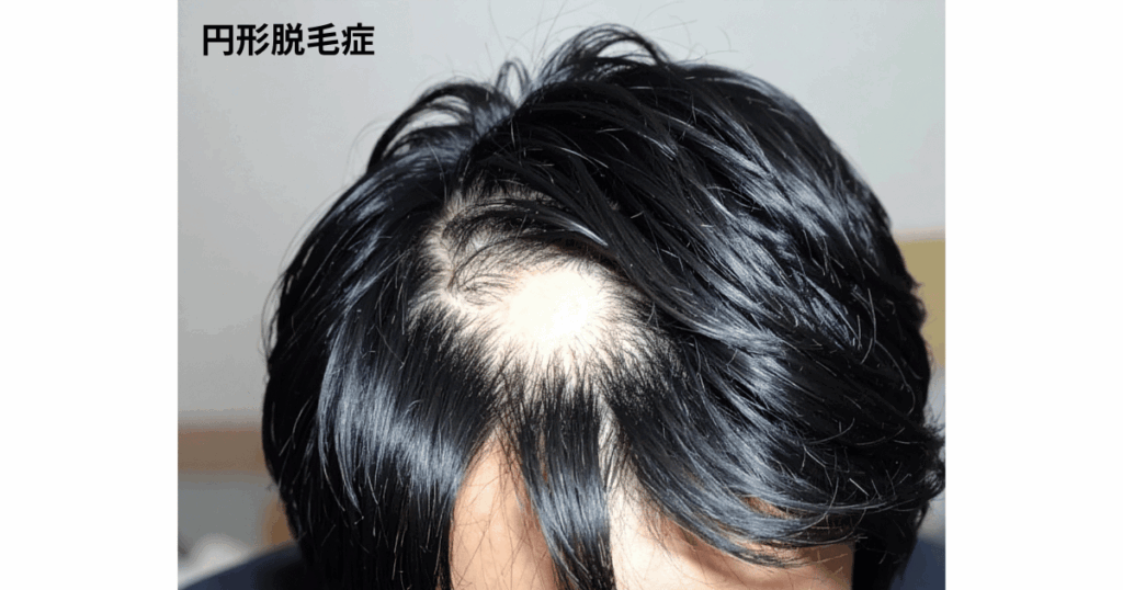 円形脱毛症
