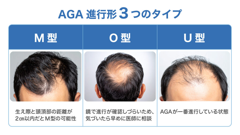 AGA進行形3つのタイプ